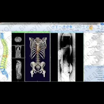 Программное обеспечение для МРТ mediCAD 3D Spine