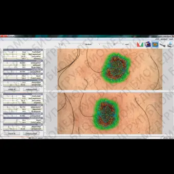 Программное обеспечение дерматология MoleExpertMicro