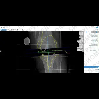 Модуль программного обеспечения для предоперационного планирования mediCAD Web