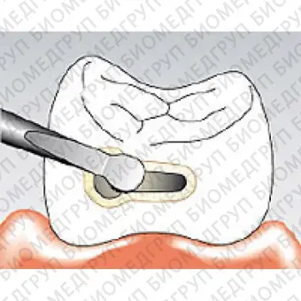 Sonicflex micro 31  насадка для минимально инвазивной терапии кариеса с алмазным покрытием, малая полусфера, дистальная