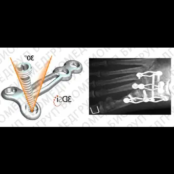 Компрессионная костная пластина предплюсна CLAW II
