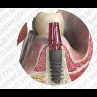 Конический зубной имплантат Rootform
