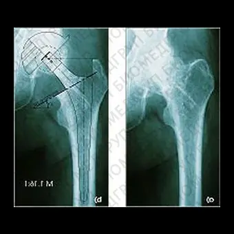 Протез бедренной кости без цемента VektorTITAN