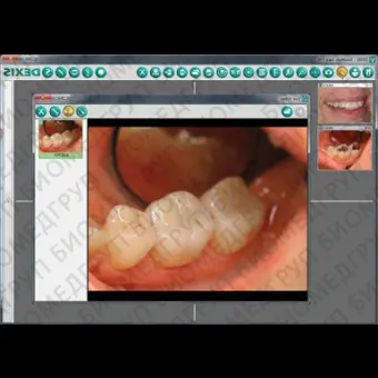 Программное обеспечение для обработки снимков зубов DEXIS