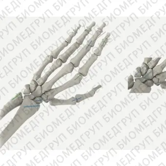 Компрессирующий винт для кости для артродеза межфалангового сустава кисти руки REDUCT