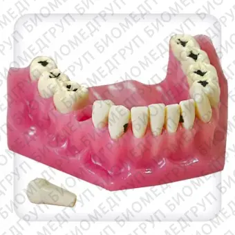 Модель верхней и нижней челюстей с 32 модельными зубами для лечения кариеса