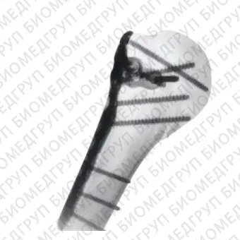 Компрессионная костная пластина плечевая кость PHL 2