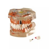 TOOTH MODEL P-TYPE - прозрачная демонстрационная модель челюсти