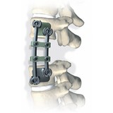 Пластина (скоба) XIA anterior, с двумя отверстиями, каудальная, средняя